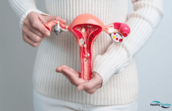 The Benefits of Hysterectomy for Fibroids in Turkey